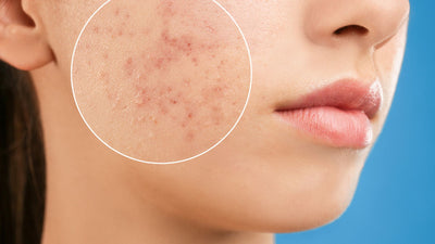 9 Acne Myths Busted: The Real Facts You Need to Know