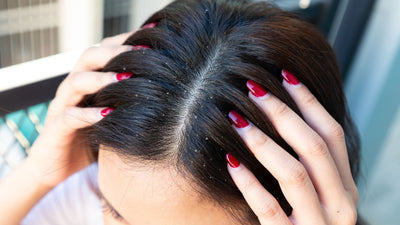 How To Remove Dandruff from Hair: A Complete Guide