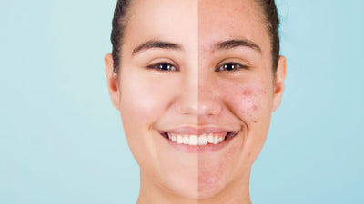 Vanishing Act: How Long Does It Take Acne Marks to Fade?